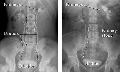 home remedies for kidney stones